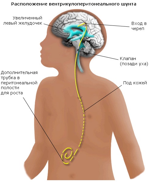 Наружная заместительная гидроцефалия головного мозга у взрослых. Что это такое, прогноз лечение