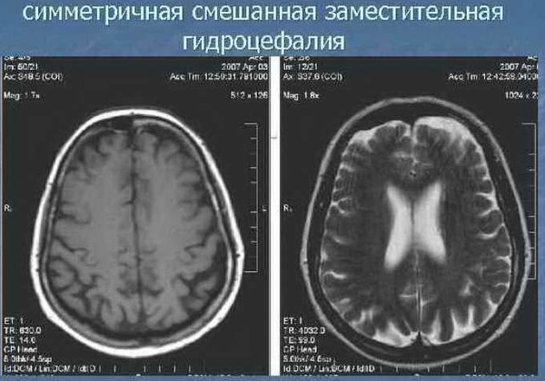 Наружная заместительная гидроцефалия головного мозга у взрослых. Что это такое, прогноз лечение