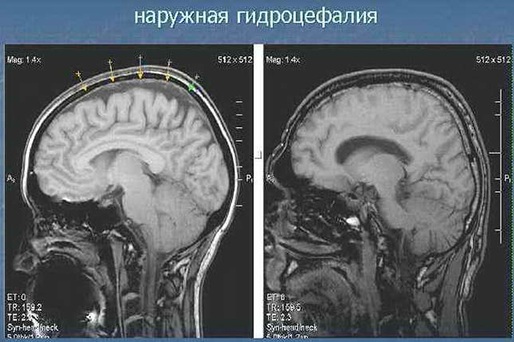 Наружная заместительная гидроцефалия головного мозга у взрослых. Что это такое, прогноз лечение