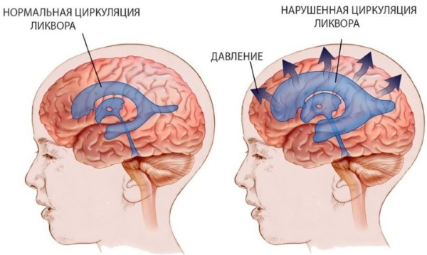 Наружная заместительная гидроцефалия головного мозга у взрослых. Что это такое, прогноз лечение