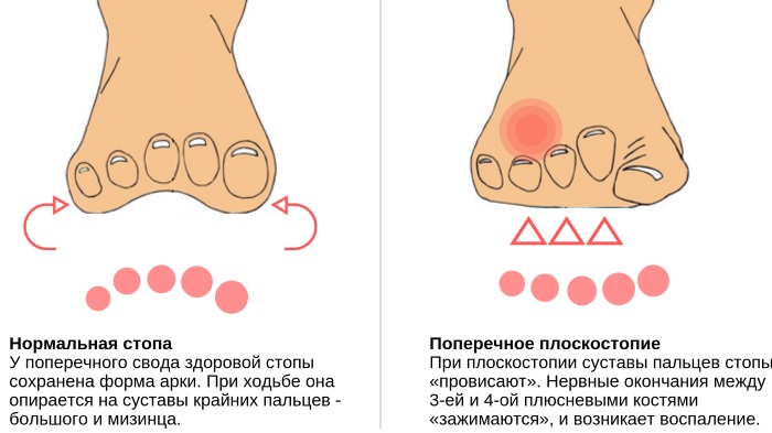 Неврома стопы (неврома Мортона). Симптомы и лечение, признаки, к какому врачу обращаться