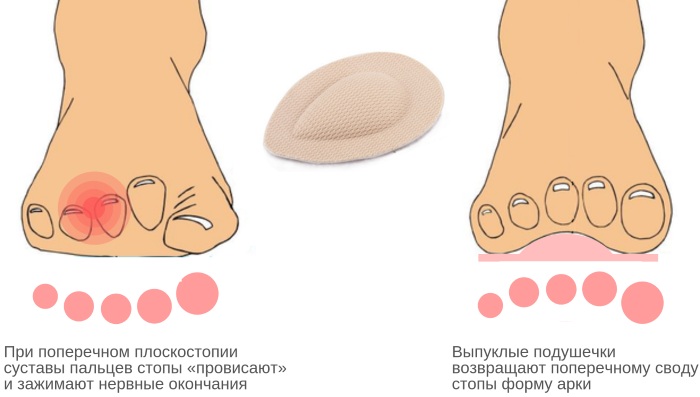 Неврома стопы (неврома Мортона). Симптомы и лечение, признаки, к какому врачу обращаться
