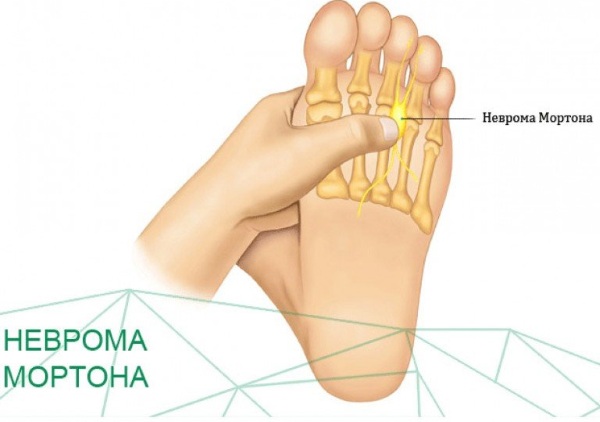 Неврома стопы (неврома Мортона). Симптомы и лечение, признаки, к какому врачу обращаться