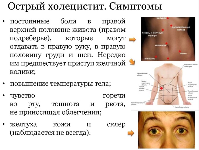 Хронический калькулезный холецистит. Симптомы и лечение, клинические рекомендации