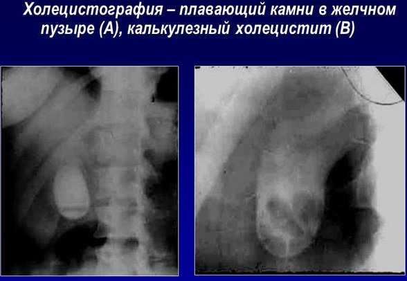 Обострение хронического холецистита. Лечение, симптомы, что провоцирует, диета