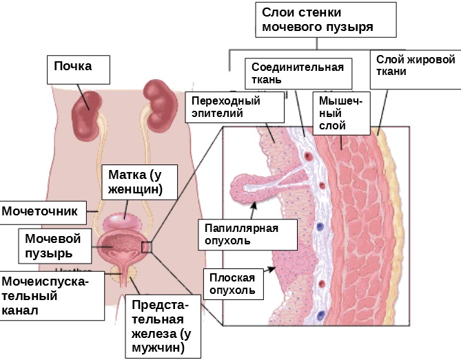 Опухоль мочевого пузыря. Симптомы у женщин, мужчин, классификация, лечение, прогноз