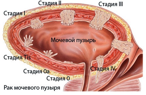 Опухоль мочевого пузыря. Симптомы у женщин, мужчин, классификация, лечение, прогноз