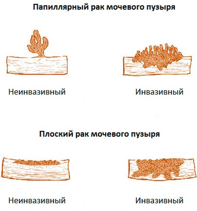 Опухоль мочевого пузыря. Симптомы у женщин, мужчин, классификация, лечение, прогноз