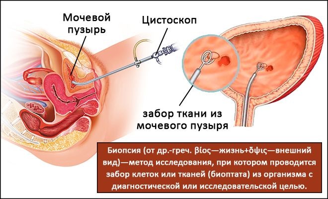 Опухоль мочевого пузыря. Симптомы у женщин, мужчин, классификация, лечение, прогноз