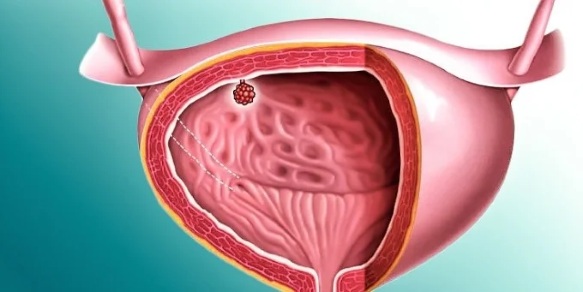 Опухоль мочевого пузыря. Симптомы у женщин, мужчин, классификация, лечение, прогноз