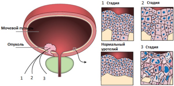 Опухоль мочевого пузыря. Симптомы у женщин, мужчин, классификация, лечение, прогноз