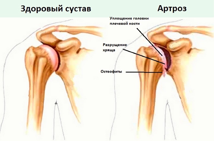 Остеоартроз плечевого сустава 1-2-3 степени. Лечение, гимнастика, симптомы, диета