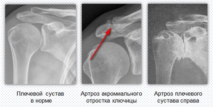 Остеоартроз плечевого сустава 1-2-3 степени. Лечение, гимнастика, симптомы, диета