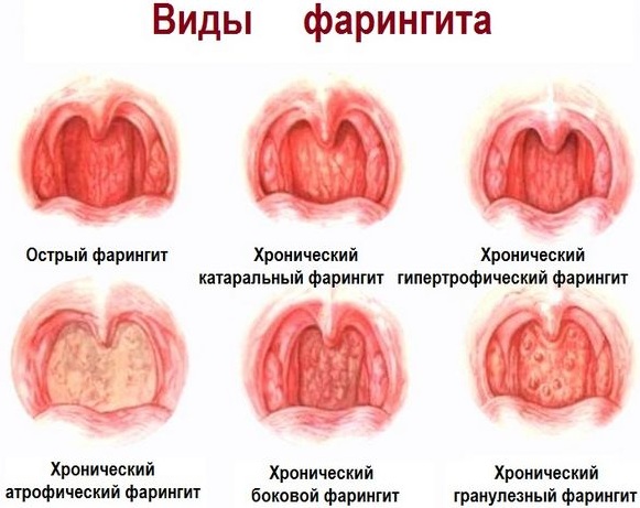 Острый фарингит. Что это такое, признаки, лечение, клинические рекомендации