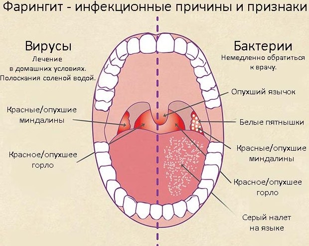 Воспаление задней стенки горла: красная, болит, пупырышки