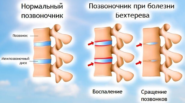 Парестезия конечностей. Что это такое, симптомы, лечение медикаментозное, народными средствами