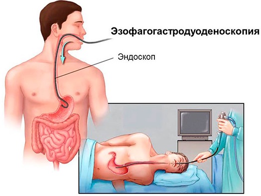 Полип в желудке. Симптомы, причины, чем опасен, диета, лечение народными средствами, психосоматика