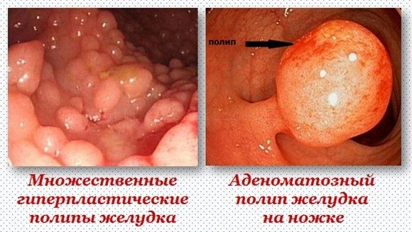 Полип в желудке. Симптомы, причины, чем опасен, диета, лечение народными средствами, психосоматика