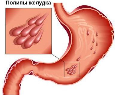 Полип в желудке. Симптомы, причины, чем опасен, диета, лечение народными средствами, психосоматика