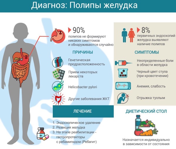 Полип в желудке. Симптомы, причины, чем опасен, диета, лечение народными средствами, психосоматика