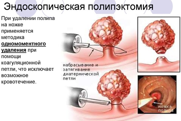 Полип в желудке. Симптомы, причины, чем опасен, диета, лечение народными средствами, психосоматика