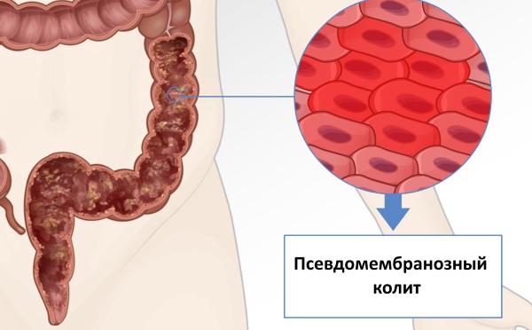 Псевдомембранозный колит (ПМК). Симптомы, лечение, диагностика, клинические рекомендации