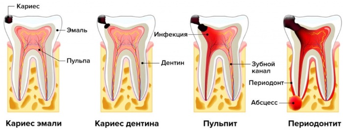 Пульпит. Лечение в домашних условиях медикаментозное, народными средствами, хронический, острый