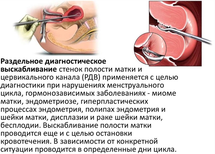 РДВ в гинекологии. Что это такое, как проводится, показания