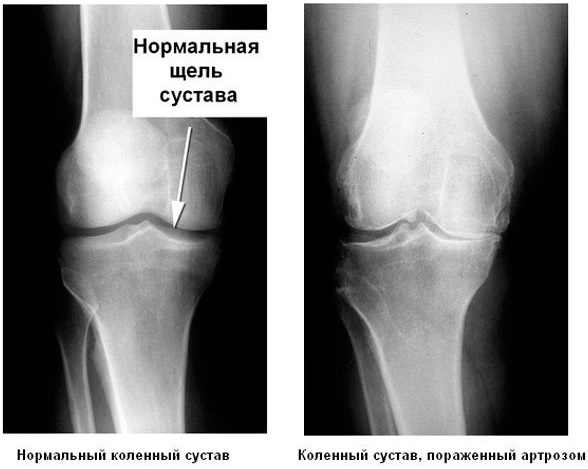 Рентген коленного сустава в двух проекциях. Цена, что показывает, как делается