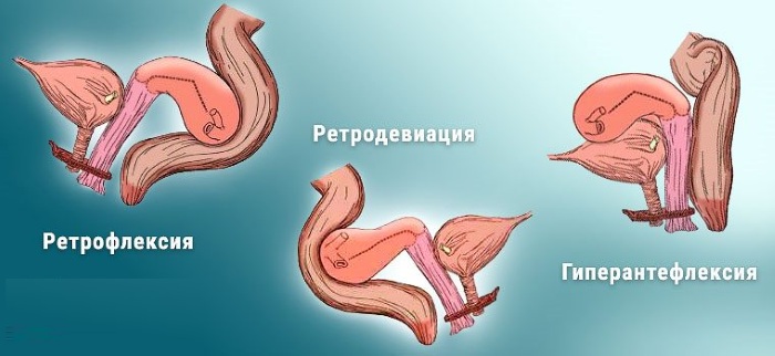 Ретродевиация матки. Что это такое, степени, как лечить, забеременеть