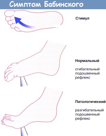 Симптом (рефлекс) Бабинского. Что это с двух сторон, справа, слева, положительный, отрицательный