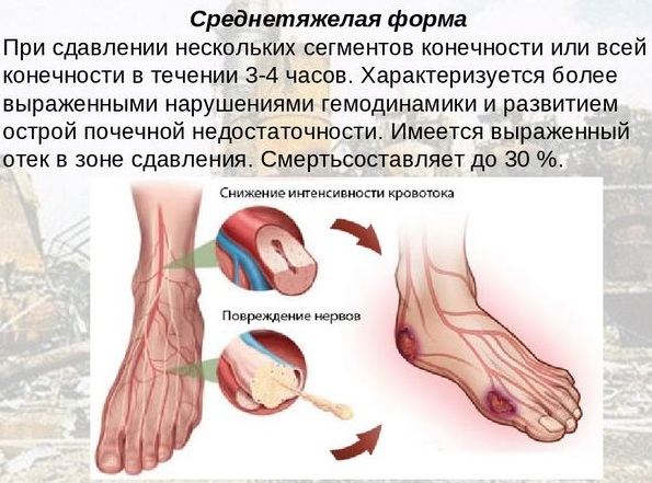 Синдром длительного сдавливания. Что это, симптомы, лечение