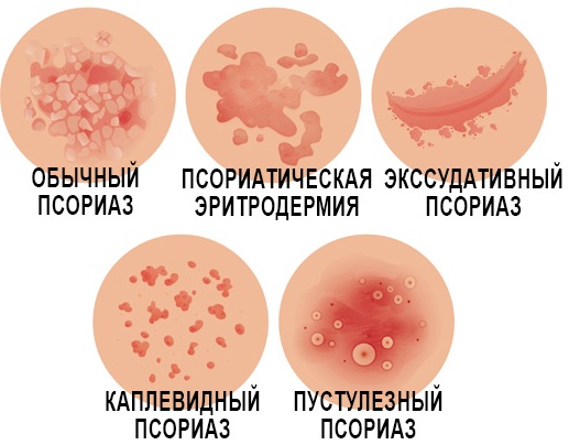 Средства от псориаза на теле, голове: народные, лучшие современные, китайские, как лечить