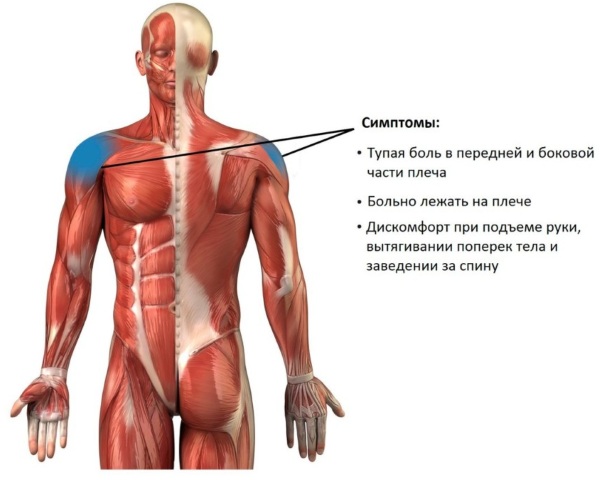 Субакромиальный импинджмент-синдром плечевого сустава. Симптомы, лечение, степени