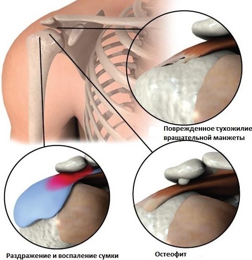 Субакромиальный импинджмент-синдром плечевого сустава. Симптомы, лечение, степени