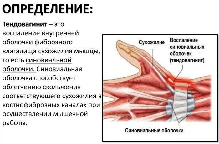 Тендовагинит плечевого сустава. Симптомы, лечение народными средствами, мазями, препаратами