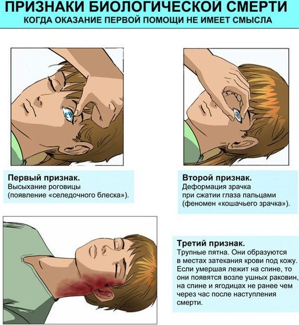 Терминальное состояние человека. Что это, стадии, способы первой помощи