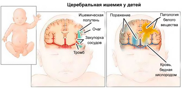 Церебральная ишемия у новорожденного 1. Что это такое, последствия, лечение, массаж, классификация