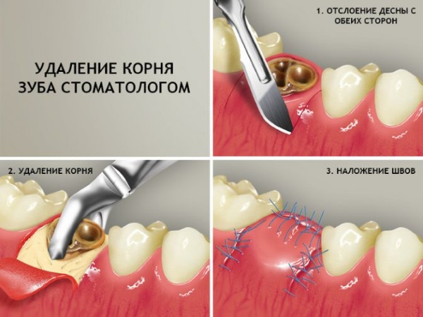 Как прорезается коренной зуб у ребенка фото