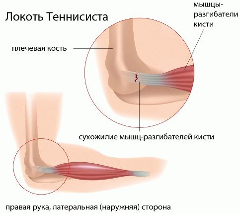 Воспаление (тендинит) сухожилий локтевого сустава. Лечение народными средствами, мазями