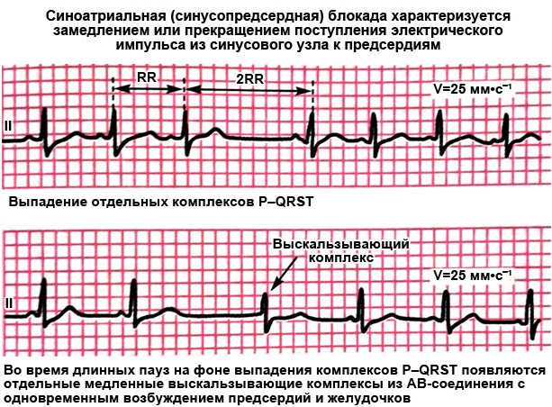 Замедление внутрипредсердной проводимости. Признаки на ЭКГ, причины, лечение