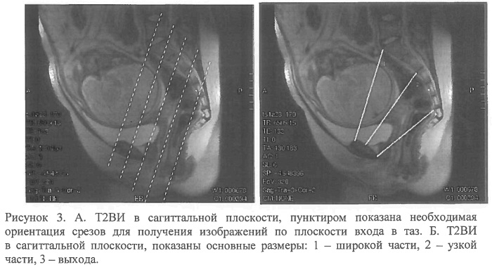 Женский таз в акушерстве. Строение, размеры, плоскости, нормы, отличия от мужского, фото