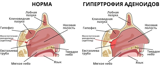 Жесткое дыхание у ребенка. Как лечить, что значит с кашлем, температурой, причины