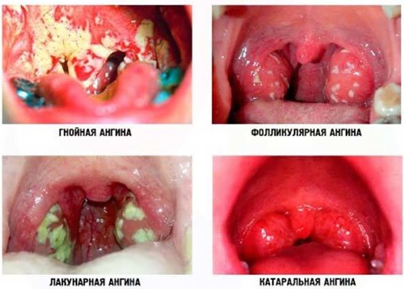 Ангина у детей. Лечение препаратами, народные средства, процедуры в домашних условиях