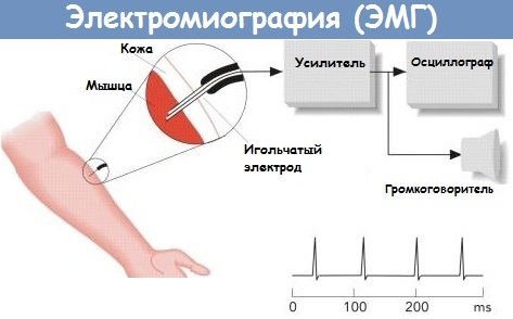 ЭНМГ нижних/верхних конечностей. Что это такое, цена обследования, как делают