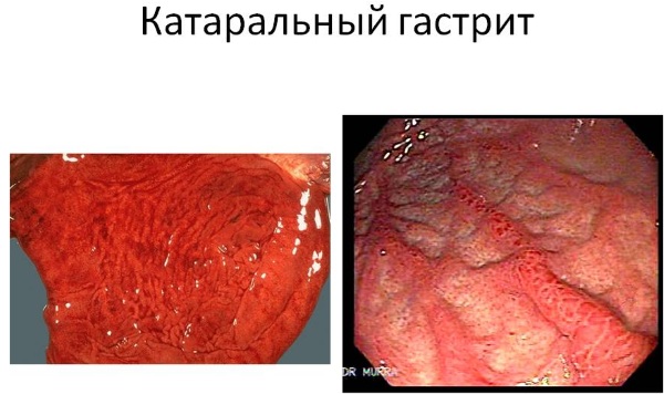 Гастрит у женщин. Симптомы и лечение, диета, народные средства, препараты