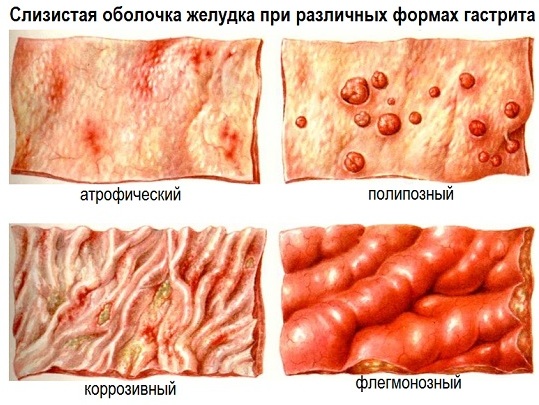 Гастрит у женщин. Симптомы и лечение, диета, народные средства, препараты