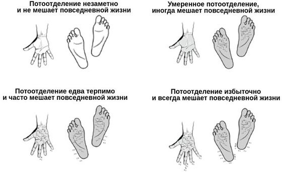 Гипергидроз ладоней и стоп. Лазерное лечение, народные средства