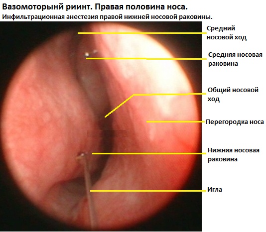 Хронический вазомоторный ринит. Лечение народными средствами, лазером, симптомы, причины