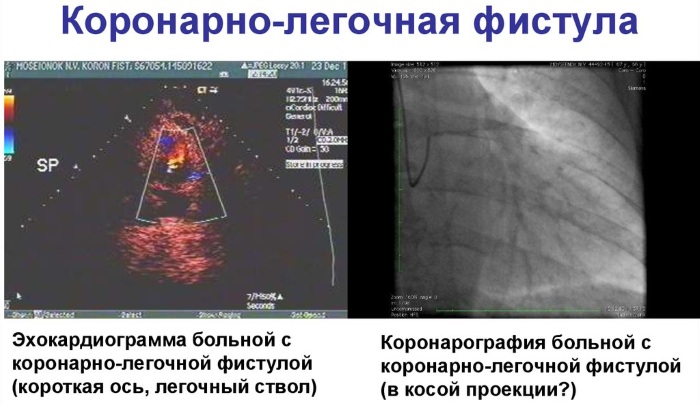 Коронарно-легочная фистула у ребенка, взрослого. Что это такое, причины, последствия, лечение